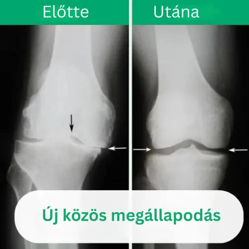 OrthoKnee™ – Hosszan tartó enyhülés ízületi gyulladás és ízületi fájdalom esetén
