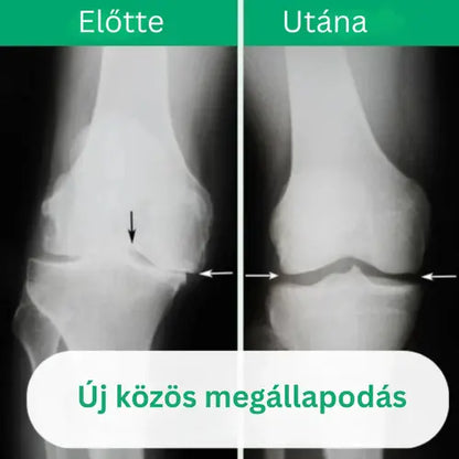 OrthoKnee™ – Hosszan tartó enyhülés ízületi gyulladás és ízületi fájdalom esetén